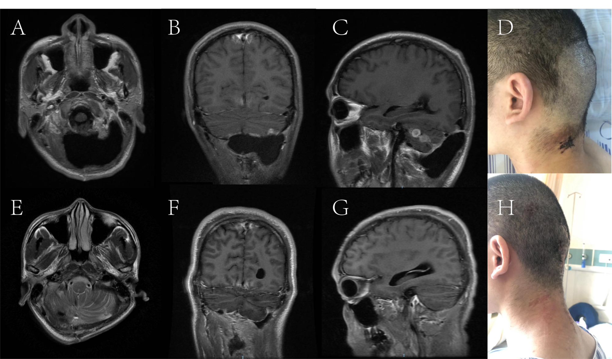 Cureus Revision Surgery Technique In The Treatment Of Refractory Subcutaneous Cerebrospinal Fluid Collection Combined With Intracranial Infection Following Posterior Fossa Surgery