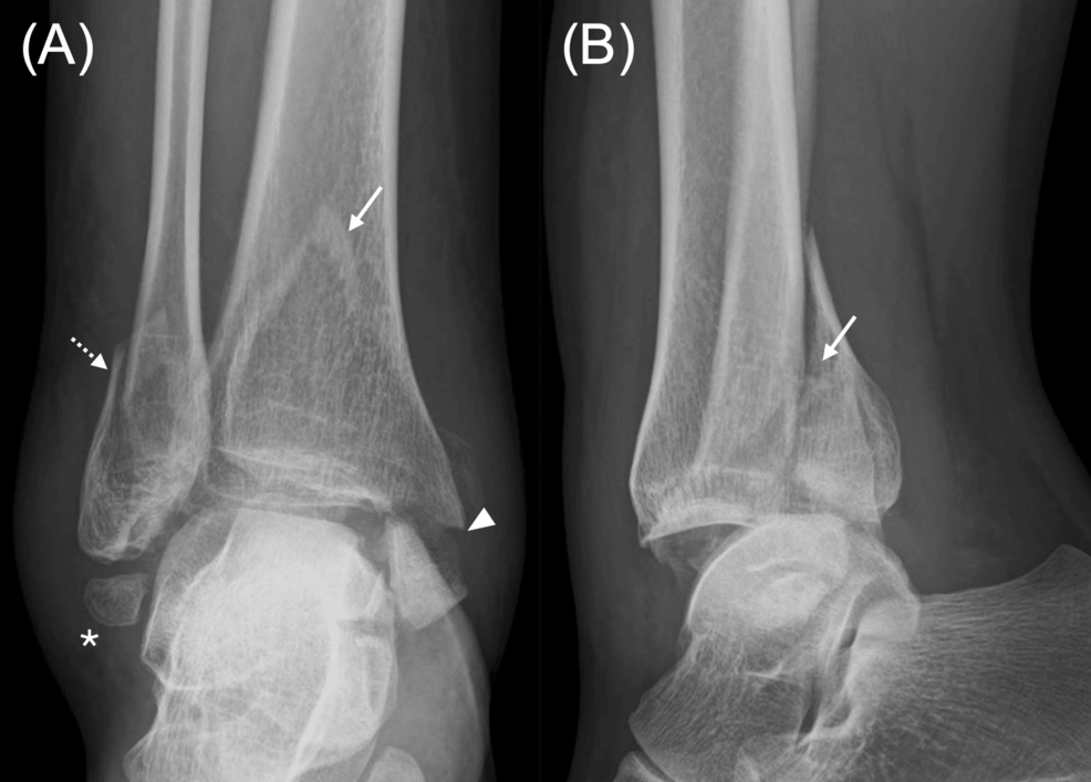Plain-radiographs-of-the-right-ankle-in-(A)-anteroposterior-and-(B)-lateral-views-before-fracture-surgery