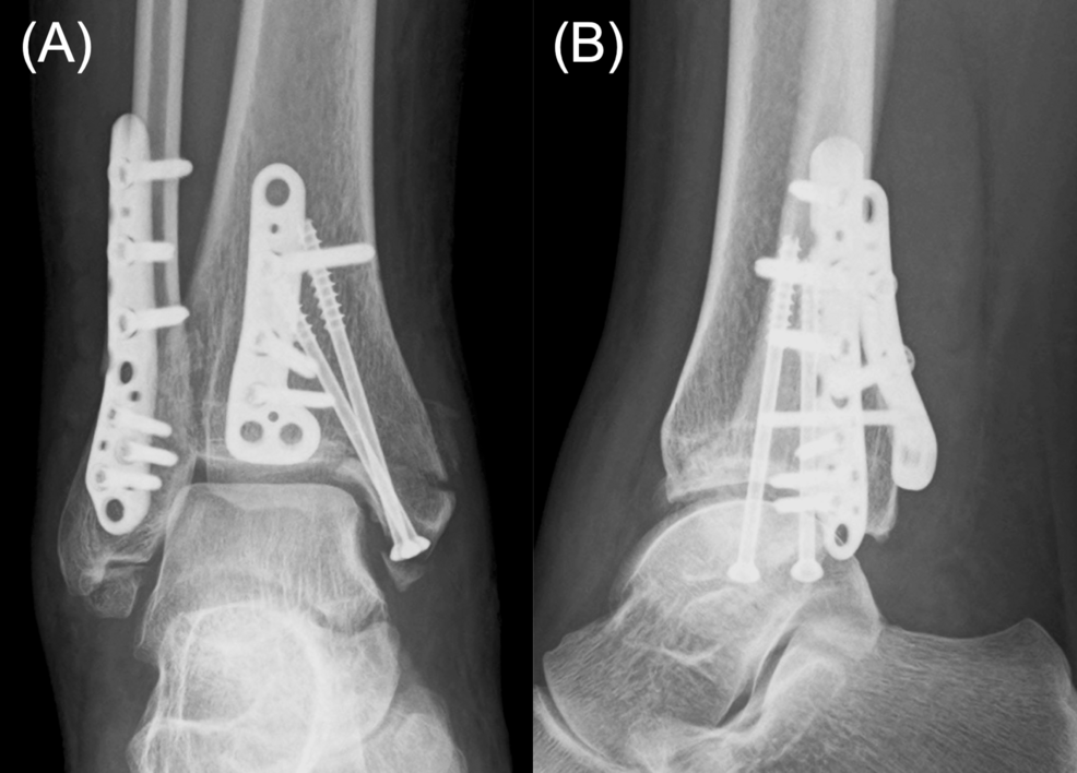 Plain-radiographs-of-the-right-ankle-in-(A)-anteroposterior-and-(B)-lateral-views-immediately-after-fracture-surgery