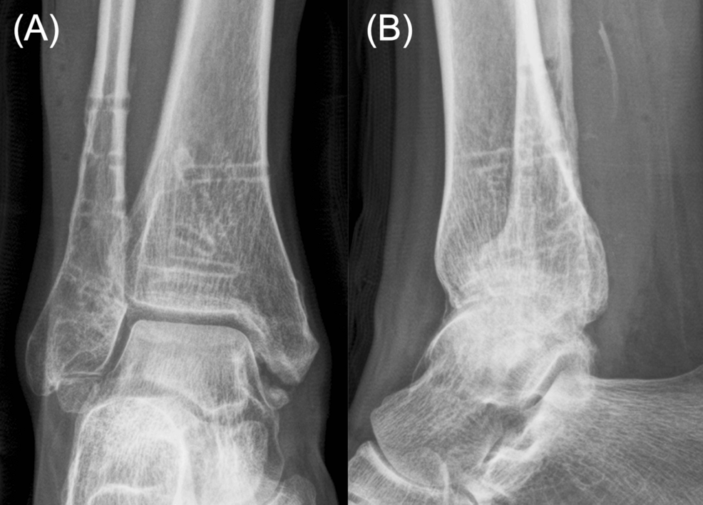 Plain-radiographs-of-the-right-ankle-in-(A)-anteroposterior-and-(A)-lateral-views-at-the-20-month-final-follow-up-after-fracture-surgery-demonstrating-bone-union-without-post-traumatic-osteoarthritis