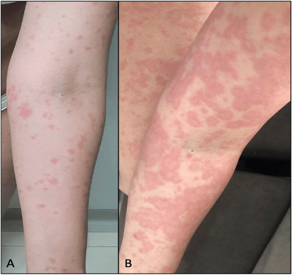 rash from smoking cigarettes Cannabis and Dermatological Implications: A Traditional Review of Adverse  Cutaneous Reactions and Systemic Risks