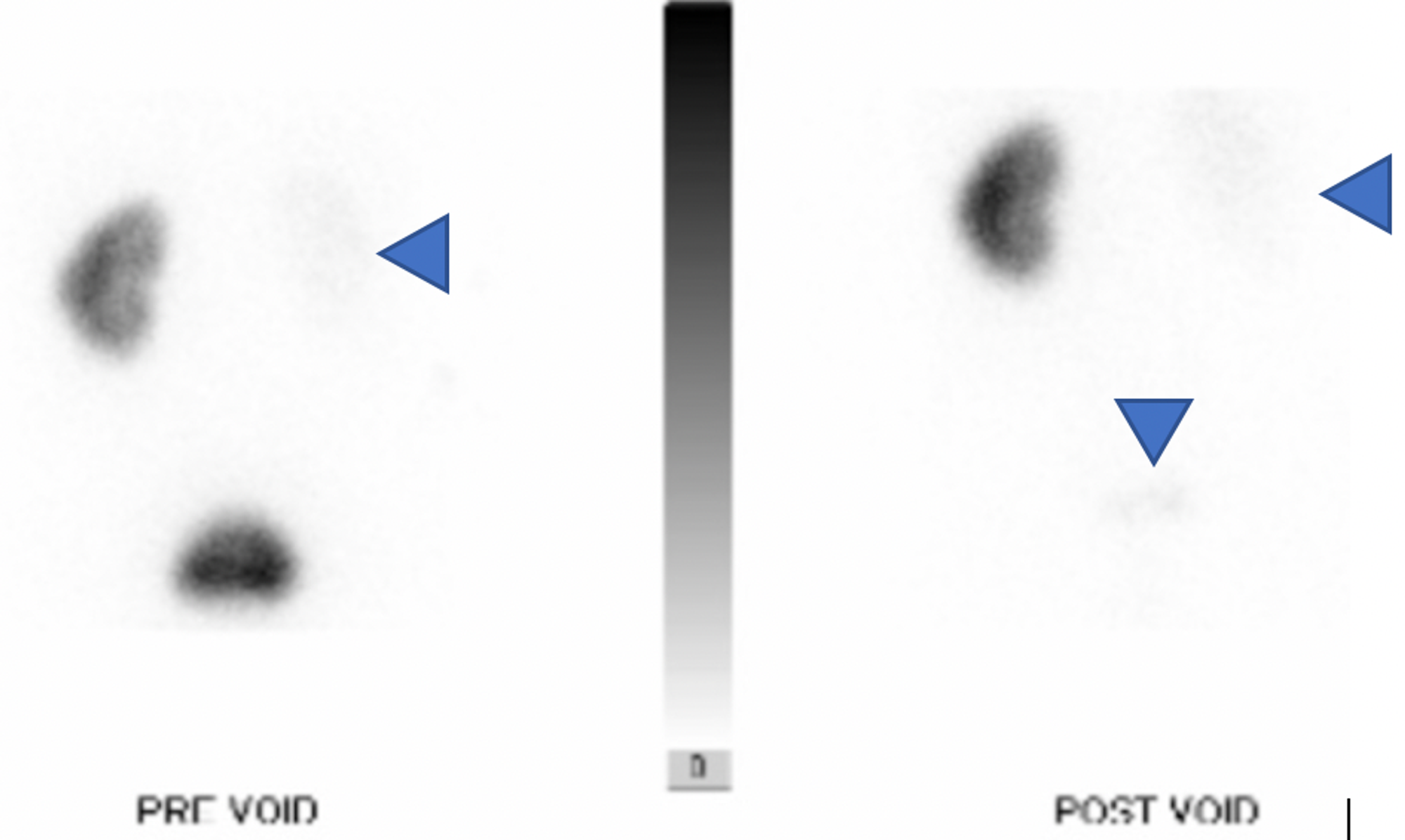 Cureus Renal Papillary Necrosis Following Mesenteric Artery Stenting