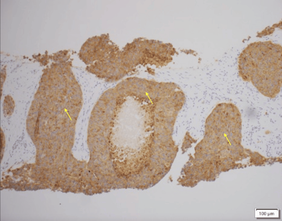Liver-tissue-section-showing-positive-synaptophysin-immunohistochemical-staining-in-neoplastic-cells,-consistent-with-a-neuroendocrine-neoplasm.