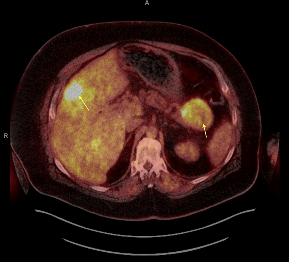 FDG-PET/CT-scan-of-the-whole-body-showing-hypermetabolic-pancreatic-tail-mass-which-measures-up-to-6.5-cm-and-multifocal-liver-hypermetabolic-metastases.-