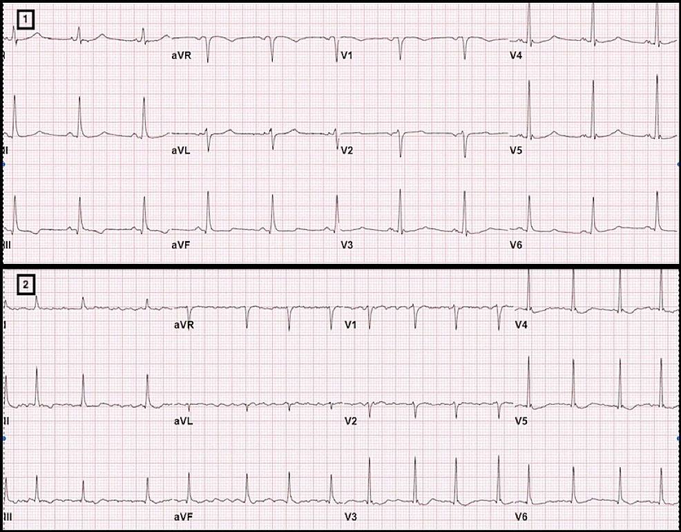 Cureus | An Interesting Case of COVID-19 Induced Reversed Takotsubo ...