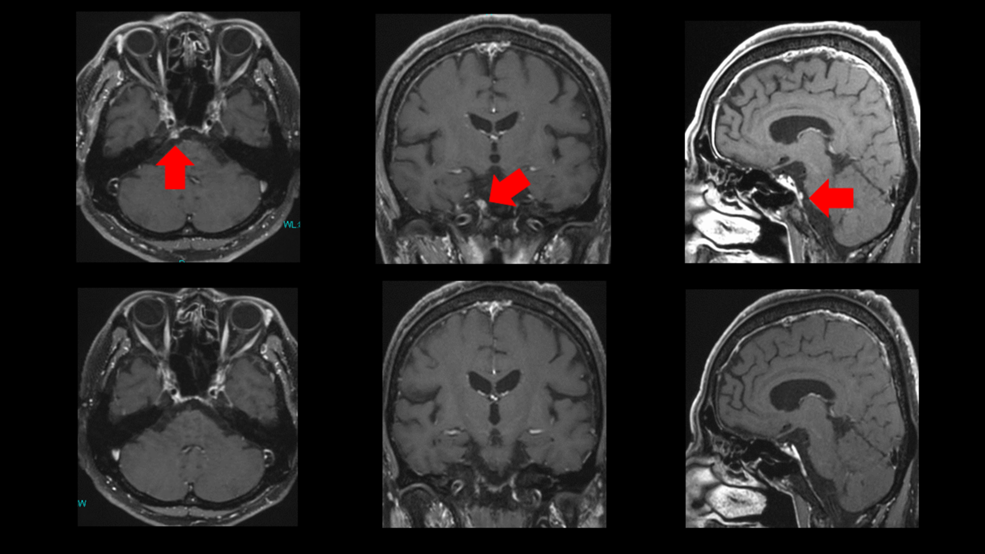 Cureus | CyberKnife Radiotherapy for Skull Base Petroclival Metastases ...