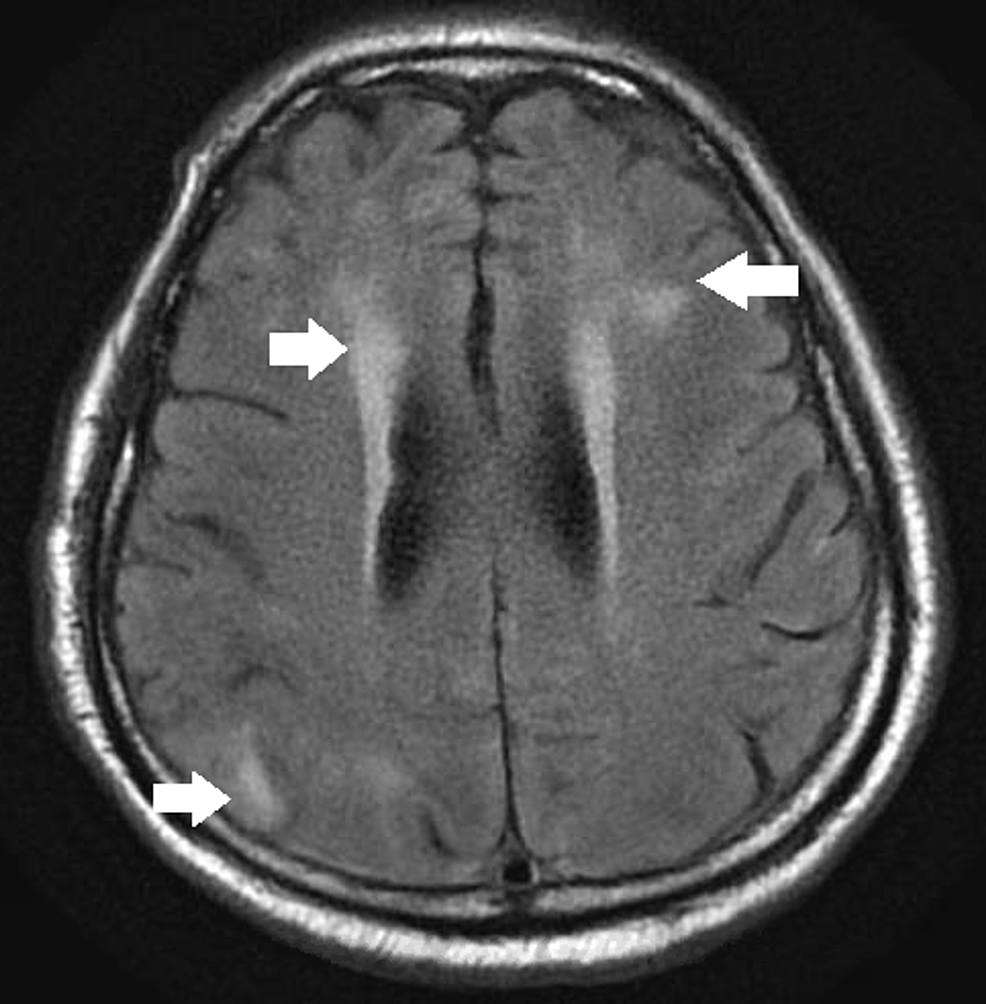 Magnetic-resonance-imaging-(MRI)-brain-without-contrast-showing-lateral-periventricular-and-right-parieto-occipital-bright-signals-concerning-for-cerebritis