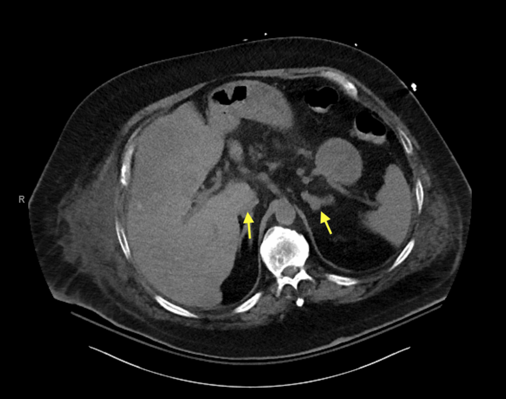CT-of-the-abdomen-and-pelvis-demonstrating-bilateral-adrenal-gland-hypertrophy.