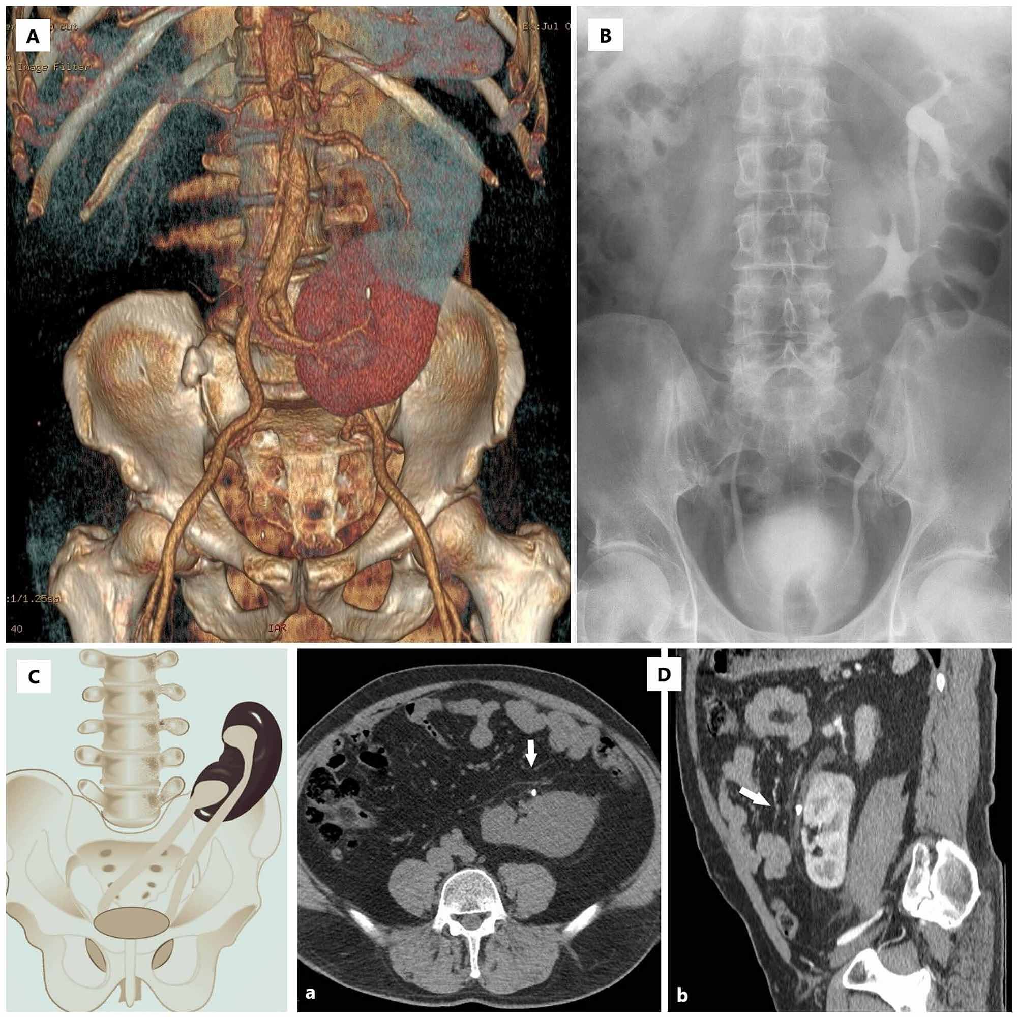 Cureus Against the Odds Management of Ureteral Calculus in Patient