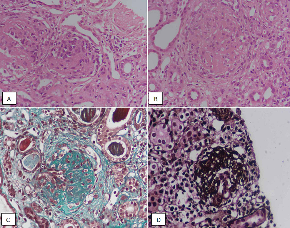 Lupus Nephritis Histology