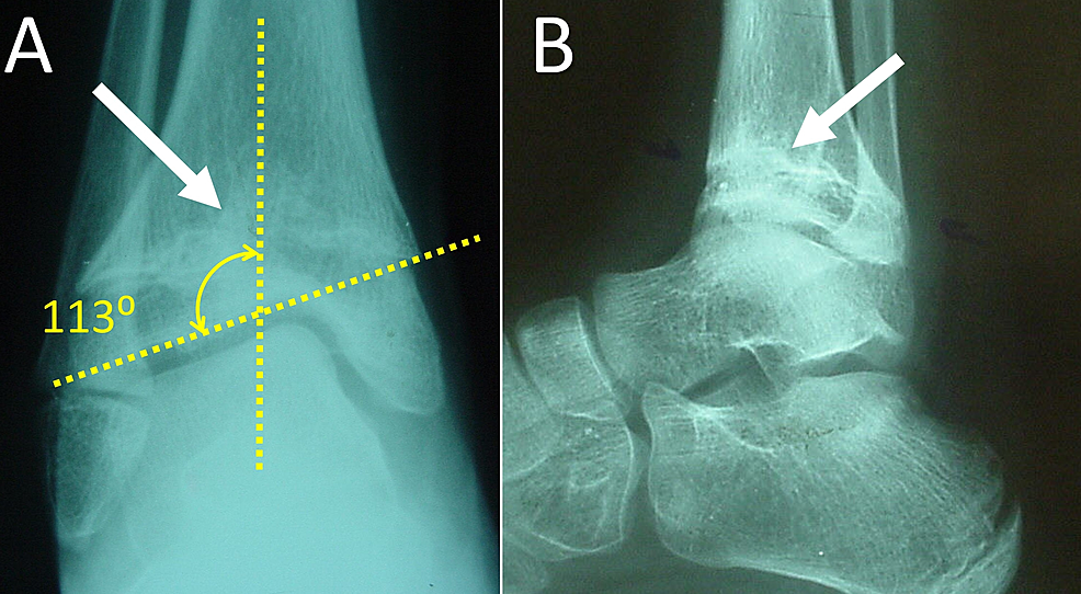 Cureus | Distal Tibia Epiphysiodesis After Saphenous Vein ...