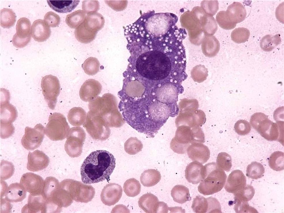 Cureus | Report of a Fatal Case of Hemophagocytic Lymphohistiocytosis ...