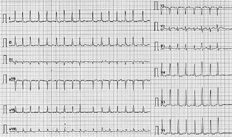 Cureus | Energy Drinks and Atrial Fibrillation: An Unusual Case of Caution