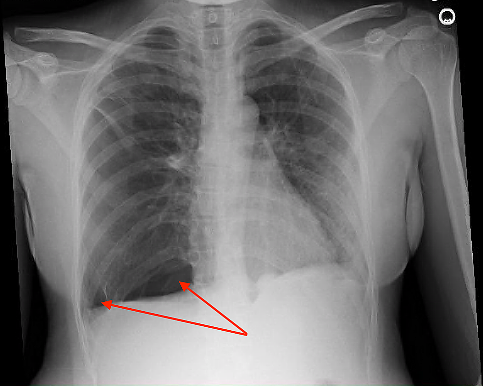 Cureus Lymphangioleiomyomatosis Presenting as Recurrent Pneumothorax