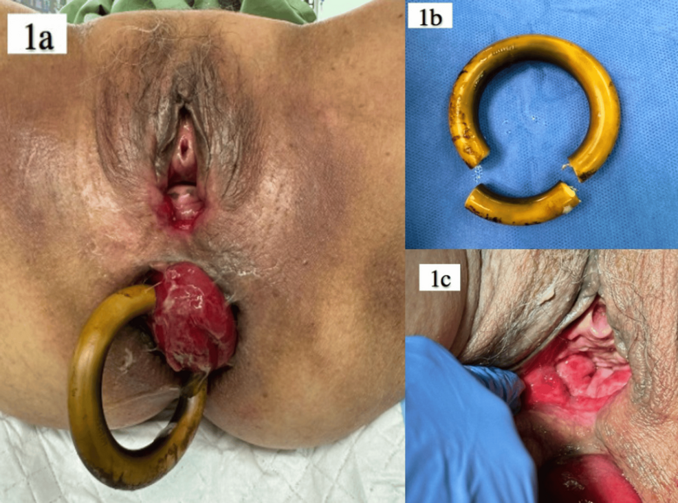 Anal va vaginal prolaps video