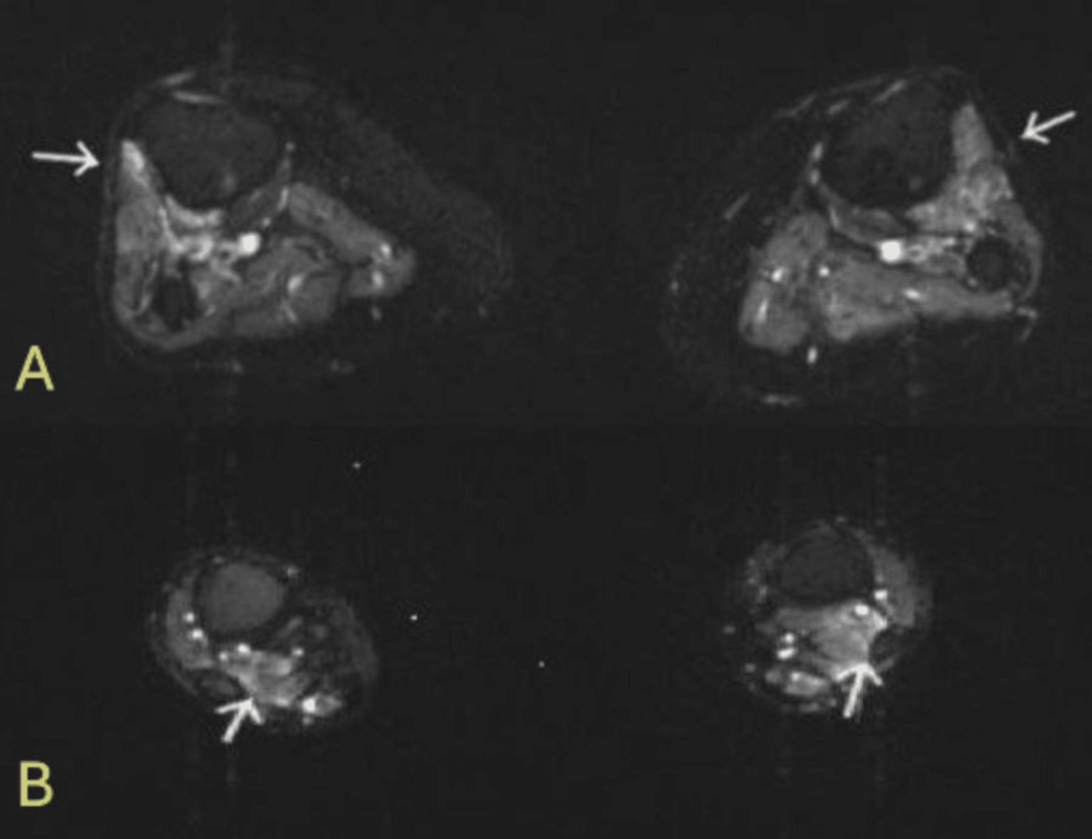 Post-viral Immune-Mediated Vasculitis Following Concurrent Dengue and ...