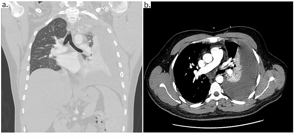 CT-scan-of-the-chest:-coronal-plane-(a)-and-cross-sectional-plane-(b)-showing-large-pleural-effusion-on-the-left-side-with-atelectasis-of-the-left-lung.