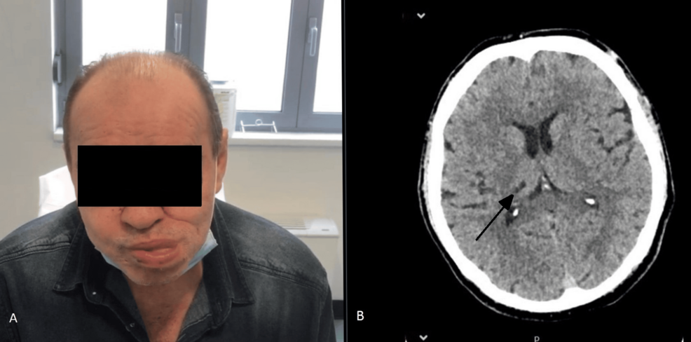 where to buy b12 injections reddit Lingual Dystonia Following Thalamic Infarction in a Patient on Methotrexate Therapy for Hidradenitis Suppurativa Cyanofar How Many?:5 Pack 🧡 OUR ROSCOE —