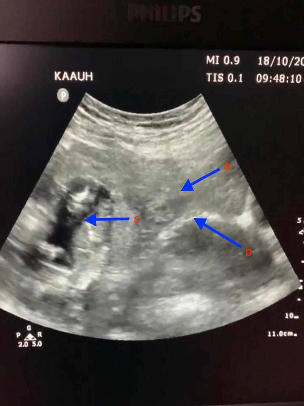 cureus-a-live-13-weeks-ruptured-ectopic-pregnancy-a-case-report