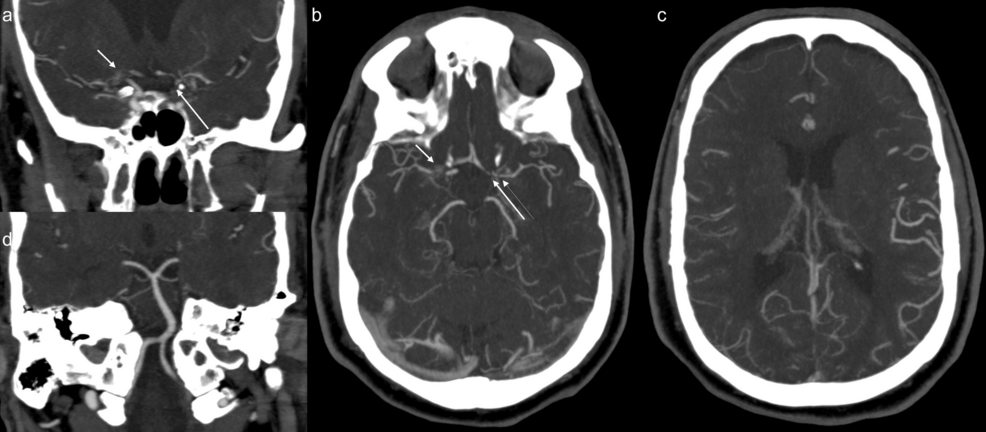CTA-head-maximum-intensity-projection-(MIP)-shows-occlusion-and-multivessel-stenosis-of-the-anterior-circulation,-with-widely-patent-posterior-circulation. CTA-head-maximum-intensity-projection-(MIP)-shows-occlusion-and-multivessel-stenosis-of-the-anterior-circulation,-with-widely-patent-posterior-circulation.