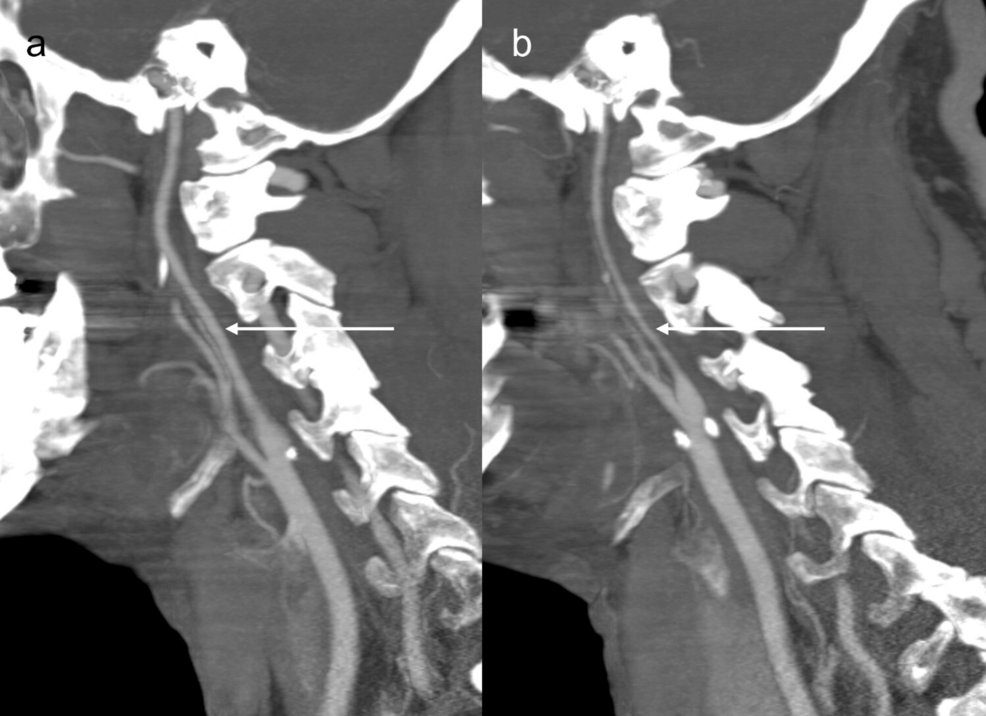 CTA-sagittal-maximum-intensity-projection-(MIP)-shows-cervical-internal-carotid-arteries-(ICAs). CTA-sagittal-maximum-intensity-projection-(MIP)-shows-cervical-internal-carotid-arteries-(ICAs).