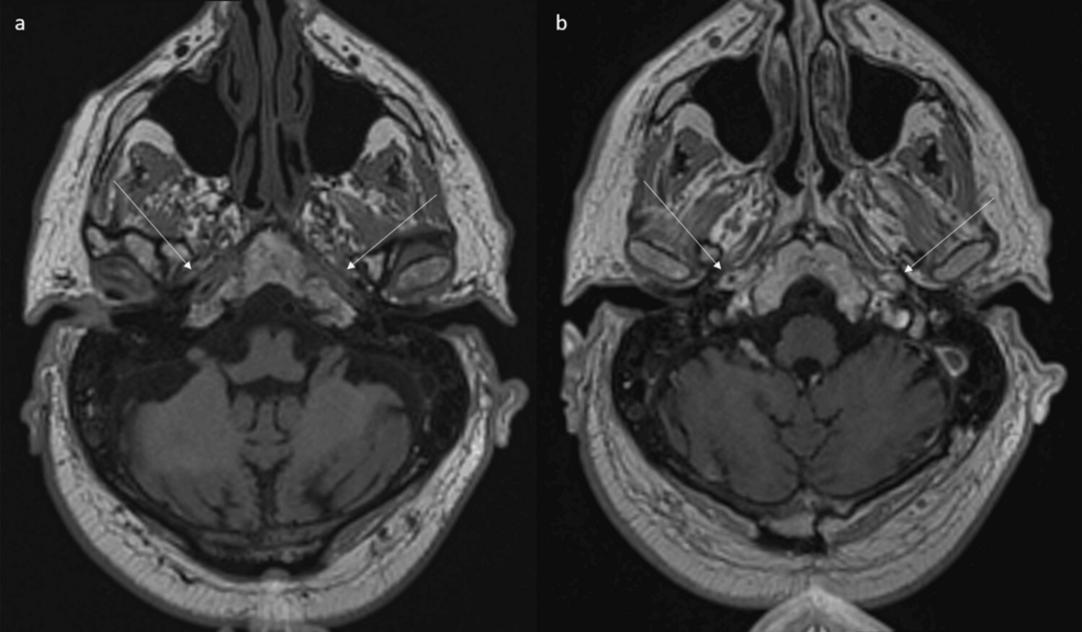 MRI-shows-abnormal-wall-thickening-and-enhancement-of-petrous-portion-of-internal-carotid-arteries. MRI-shows-abnormal-wall-thickening-and-enhancement-of-petrous-portion-of-internal-carotid-arteries.