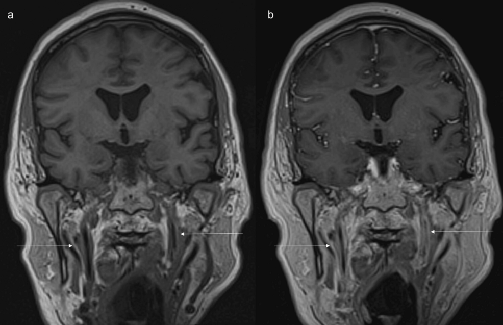 MRI-shows-long-segment-abnormal-wall-thickening-and-enhancement-of-cervical-portion-of-internal-carotid-arteries. MRI-shows-long-segment-abnormal-wall-thickening-and-enhancement-of-cervical-portion-of-internal-carotid-arteries.