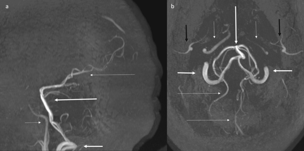 Time-of-flight-(TOF)-magnetic-resonance-angiography-(MRA)-maximum-intensity-projection-(MIP)-shows-absence-of-flow-related-enhancement-of-anterior-and-middle-cerebral-arteries,-with-attenuated-appearance-of-internal-carotid-arteries,-and-prominent-posterior-circulation-arteries. Time-of-flight-(TOF)-magnetic-resonance-angiography-(MRA)-maximum-intensity-projection-(MIP)-shows-absence-of-flow-related-enhancement-of-anterior-and-middle-cerebral-arteries,-with-attenuated-appearance-of-internal-carotid-arteries,-and-prominent-posterior-circulation-arteries.