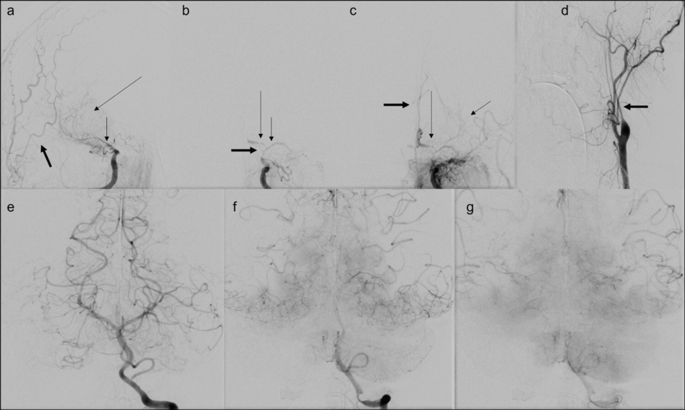 Catheter-angiography-shows-multivessel-stenosis-in-anterior-circulation-with-no-stenosis-in-posterior-circulation. Catheter-angiography-shows-multivessel-stenosis-in-anterior-circulation-with-no-stenosis-in-posterior-circulation.