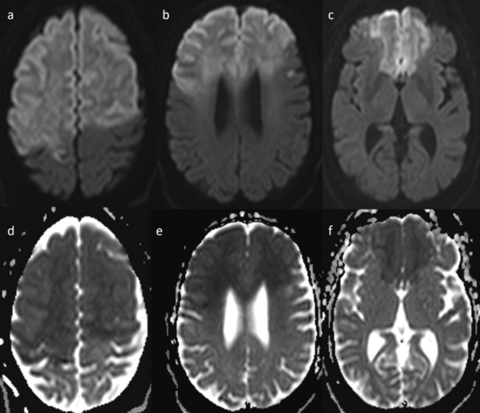 Brain-MRI-shows-confluent-early-subacute-infarcts-involving-bilateral-frontal-lobes-and-right-parietal-lobe-with-relative-sparing-of-the-inferolateral-aspect,-and-involvement-of-caudate-nuclei. Brain-MRI-shows-confluent-early-subacute-infarcts-involving-bilateral-frontal-lobes-and-right-parietal-lobe-with-relative-sparing-of-the-inferolateral-aspect,-and-involvement-of-caudate-nuclei.