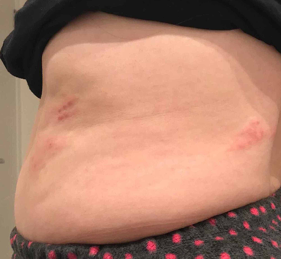 Breast rash. Is this shingles? : r/Dermatology