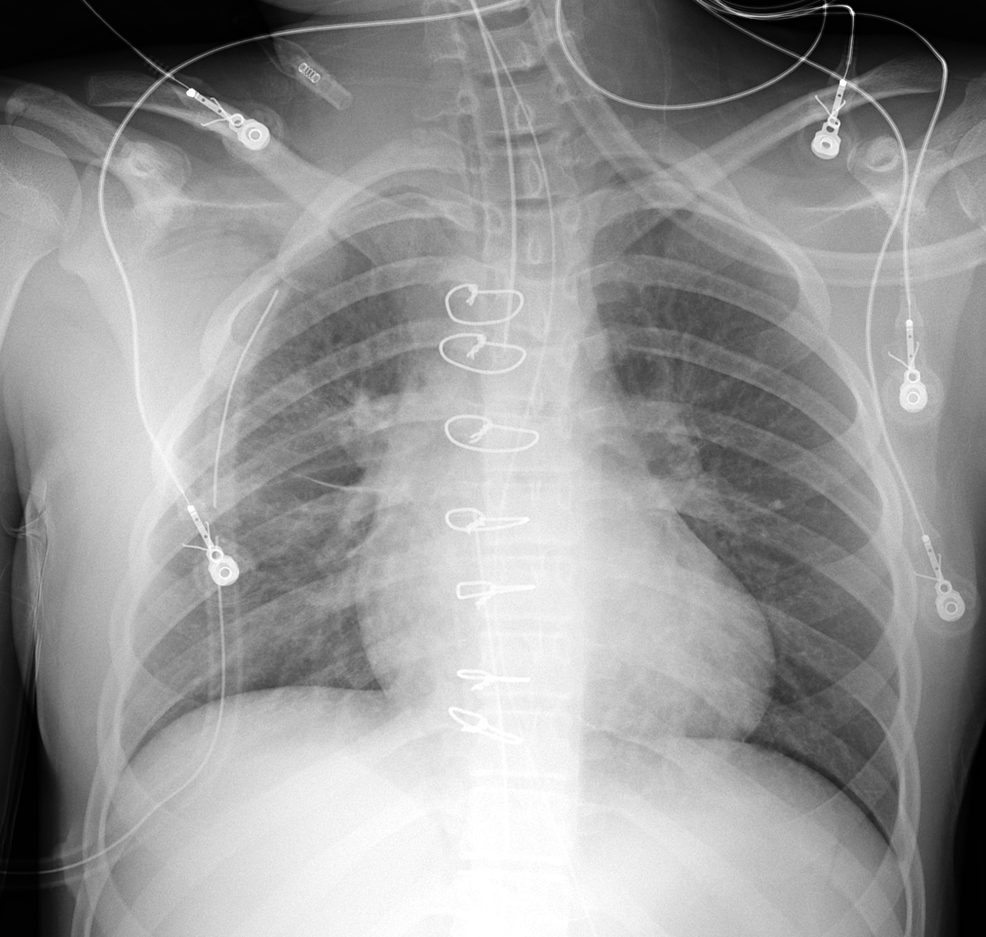 Cureus Miraculous Recovery After Trauma to the Mediastinum