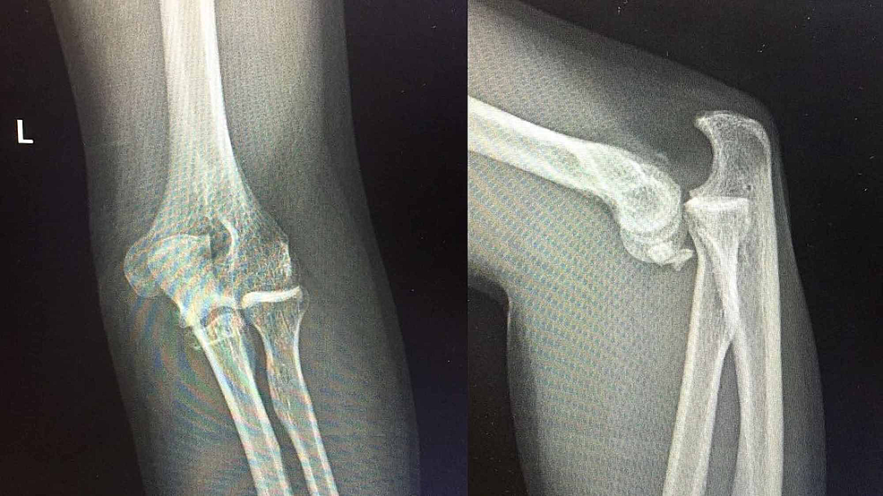 Cureus Functional of Surgically Treated Isolated Coronoid