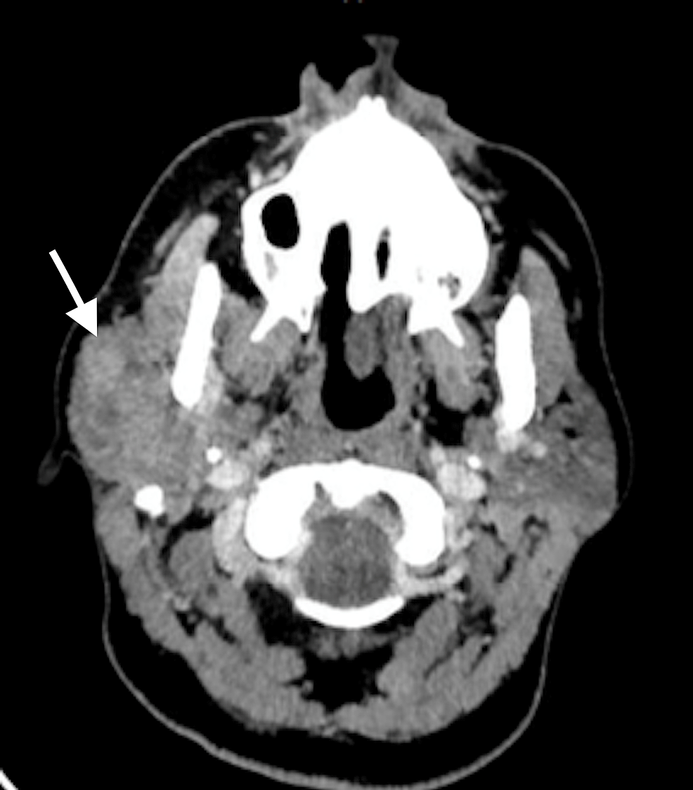 cureus-tumors-of-atypical-carcinoma-of-the-parotid-gland-and