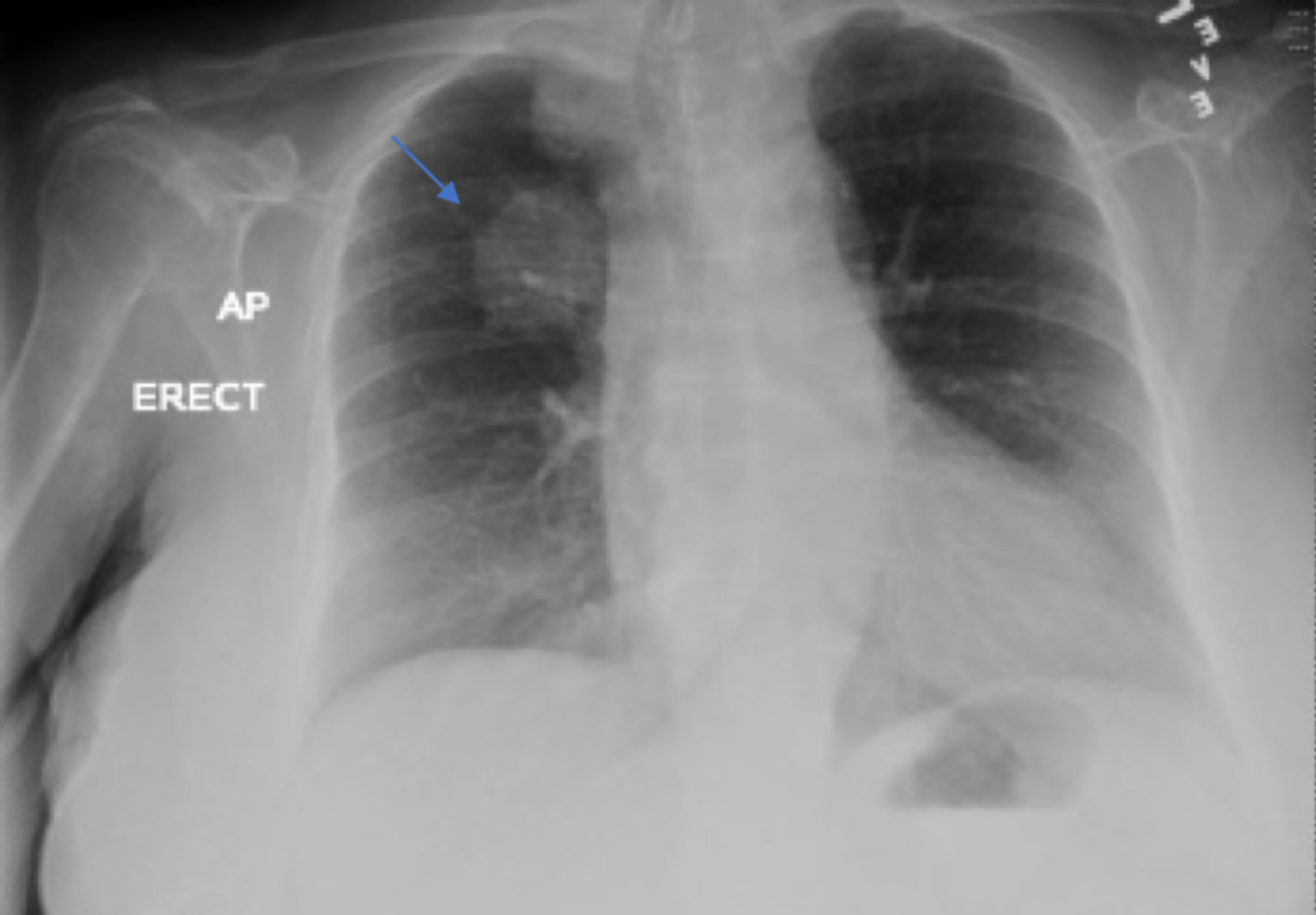 Cureus | A Case of False-Positive HIV Test in a Patient With Newly  Diagnosed Hodgkin Lymphoma and Literature Review | Article