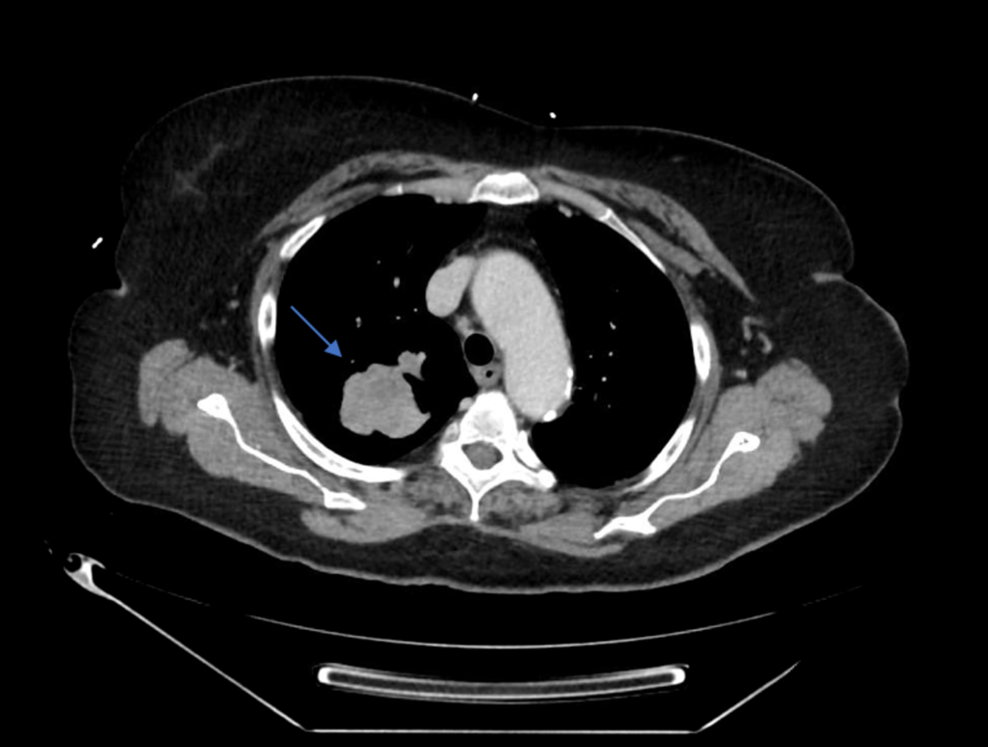 Cureus | A Case of False-Positive HIV Test in a Patient With Newly  Diagnosed Hodgkin Lymphoma and Literature Review | Article