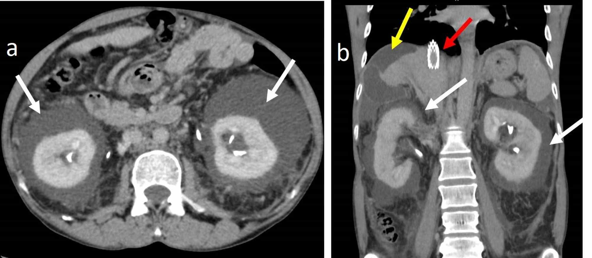 Cureus Renal Lymphangiectasia An Unusual Mimicker Of Cystic Renal Disease A Case Series And