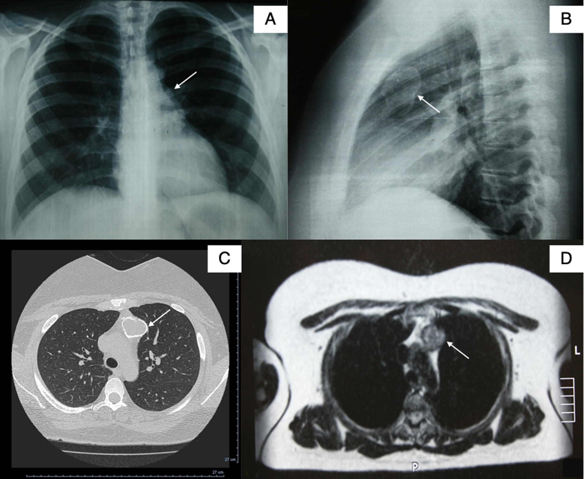 Cureus Multilocular Thymic Cyst in a Young, Otherwise Healthy Woman
