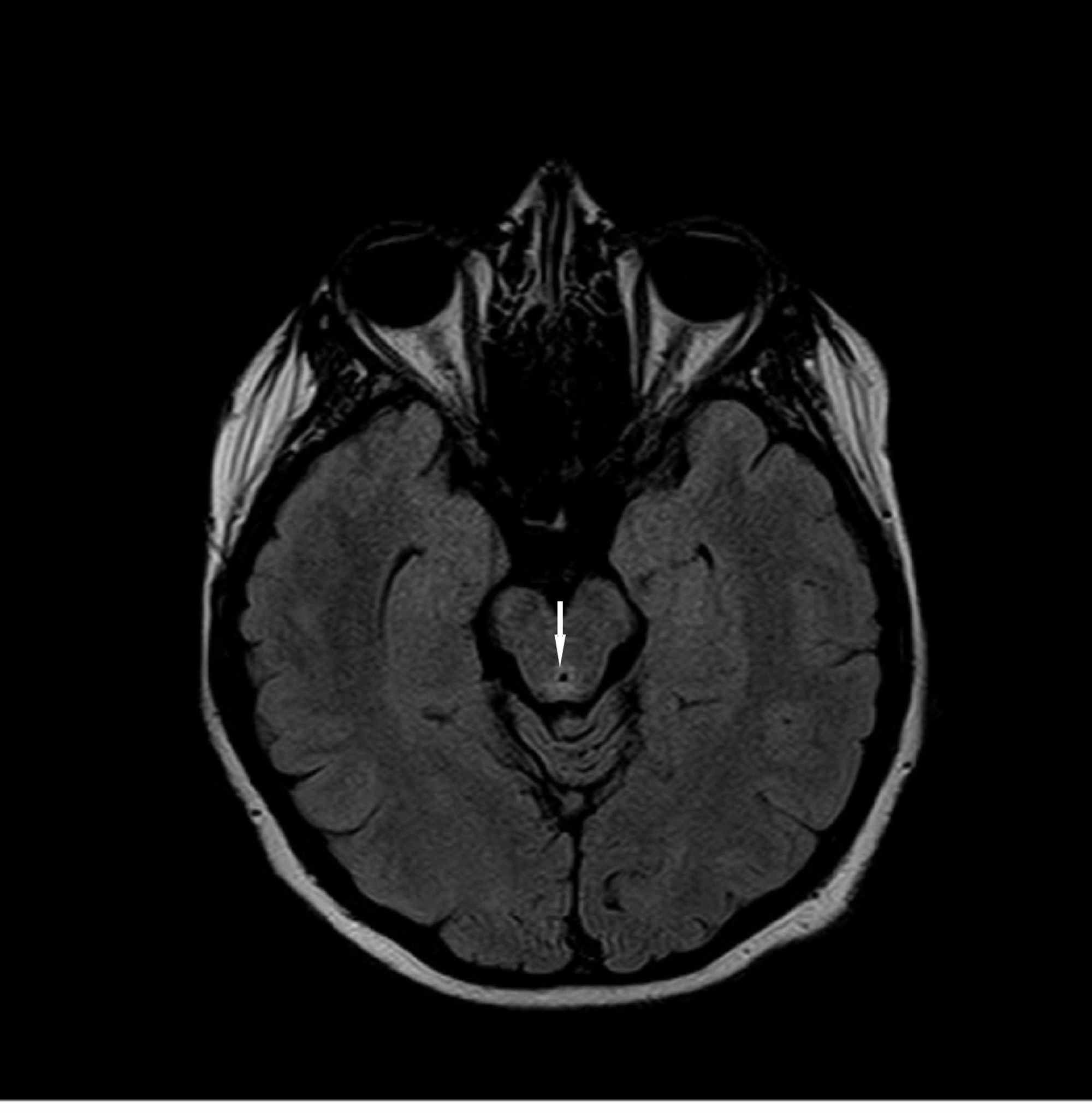 Thiamine Deficiency Mri Brain