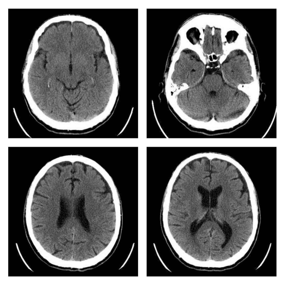 Images-from-the-brain-CT-scan-of-the-patient-demonstrating-no-abnormalities Images-from-the-brain-CT-scan-of-the-patient-demonstrating-no-abnormalities
