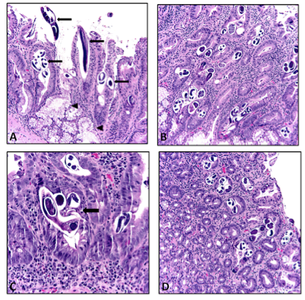 Strongyloides Skin Lesions