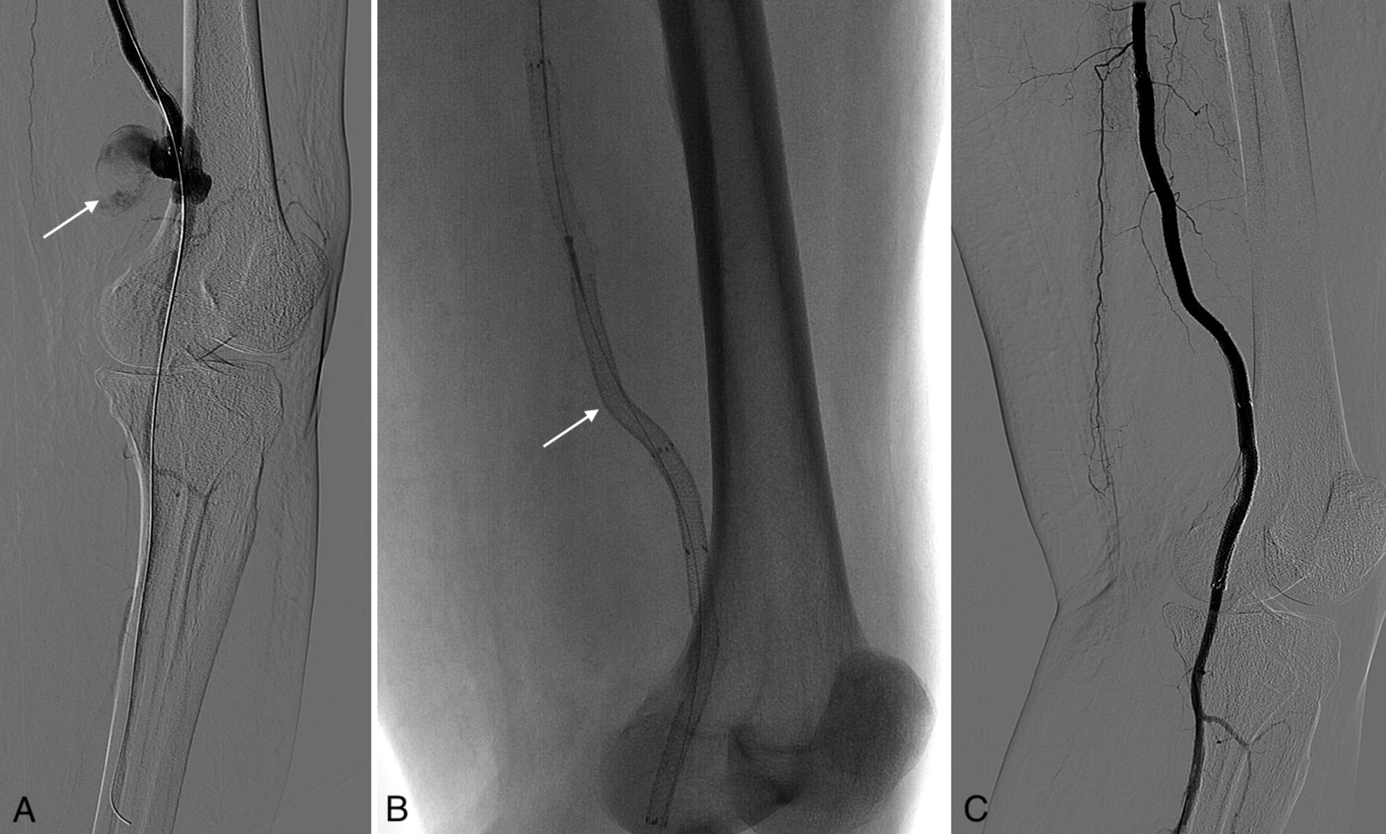 Cureus | Superficial Femoral Artery Pseudoaneurysm And Arterial Wall ...