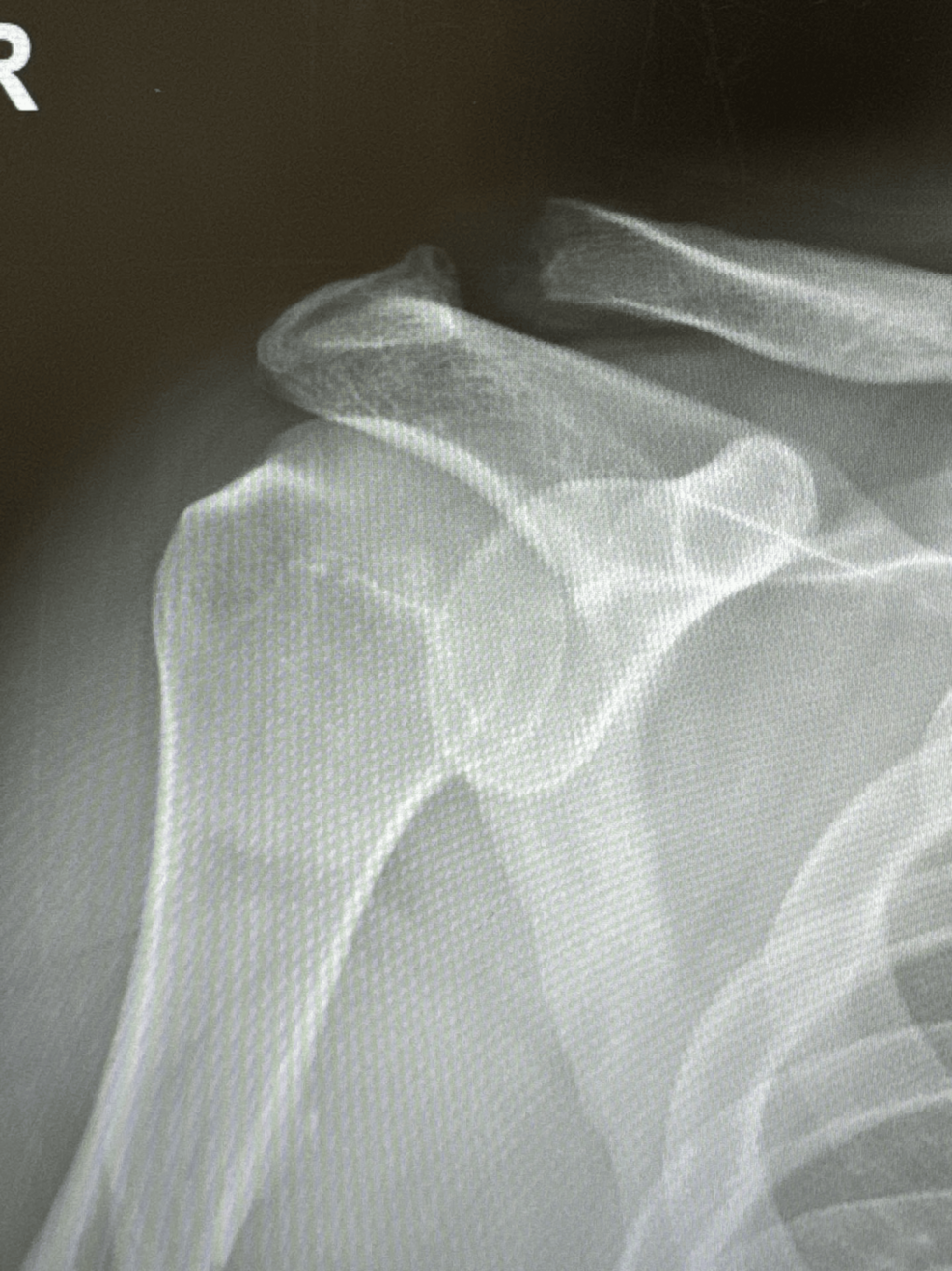 Normal Pediatric X-ray Atlas | Radiopaedia Cases | Radiopaedia.org, image size:986x1315