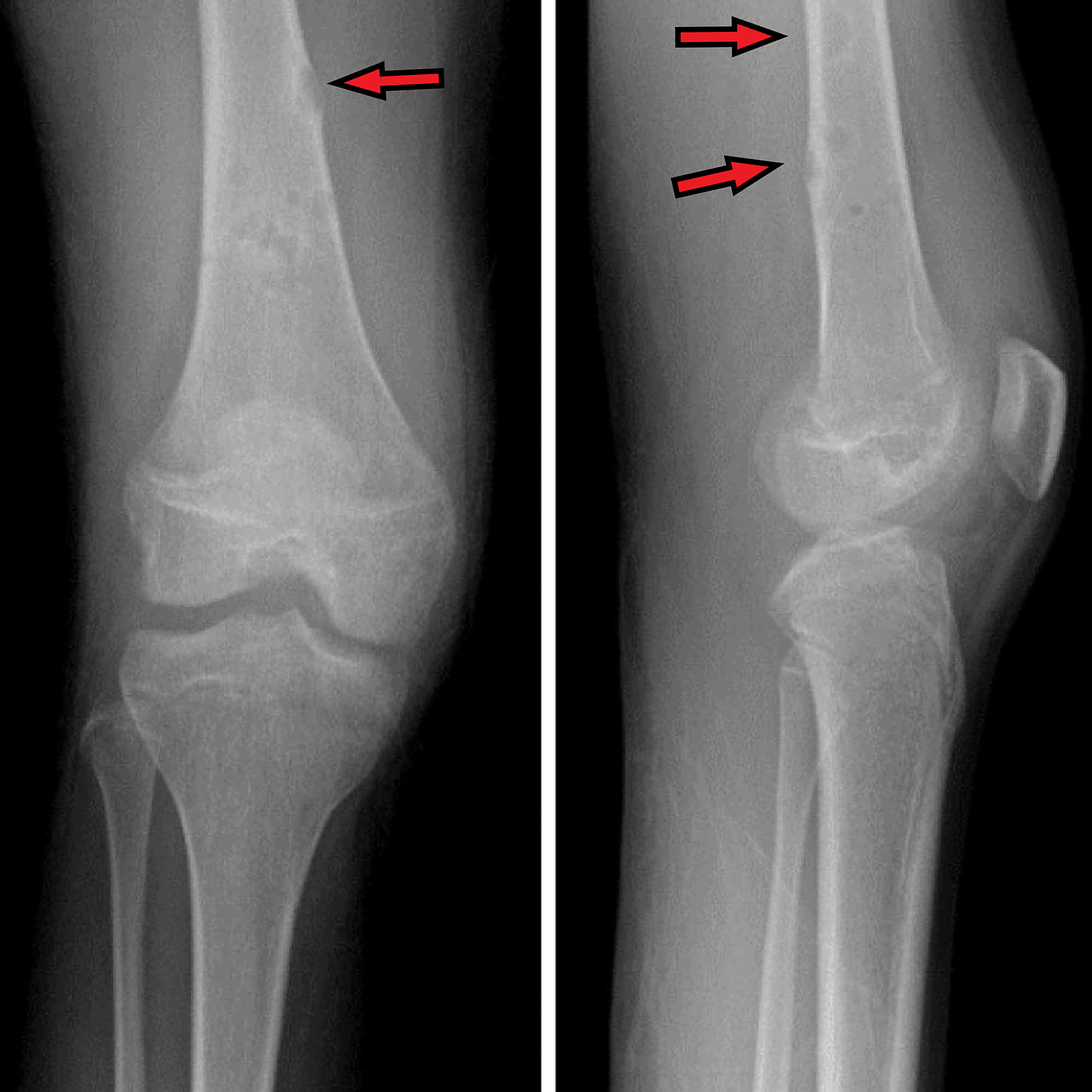 Cureus | Group B Streptococcus Osteomyelitis in a Healthy Adolescent