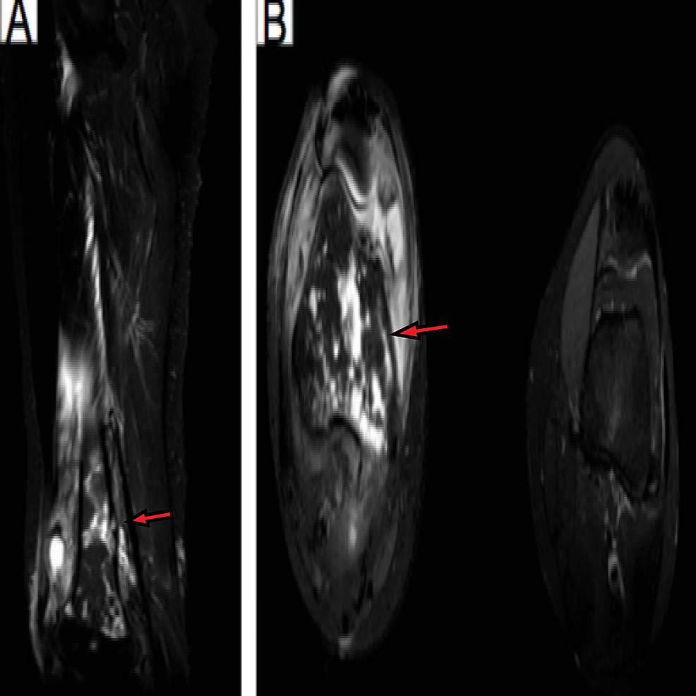 (A)-coronal-MRI-image-of-the-right-knee-(B)-axial-MRI-image-of-the-right-knee-compared-to-the-left-knee