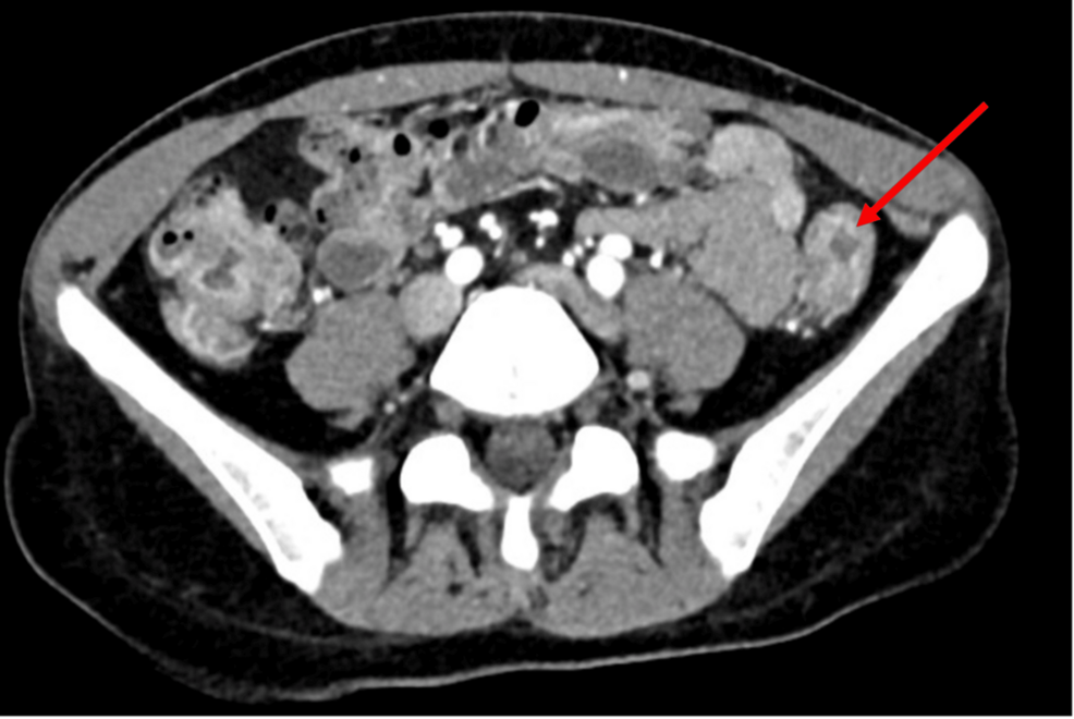 Idiopathic Spontaneous Pneumomediastinum in an Active Patient With Crohn's Disease