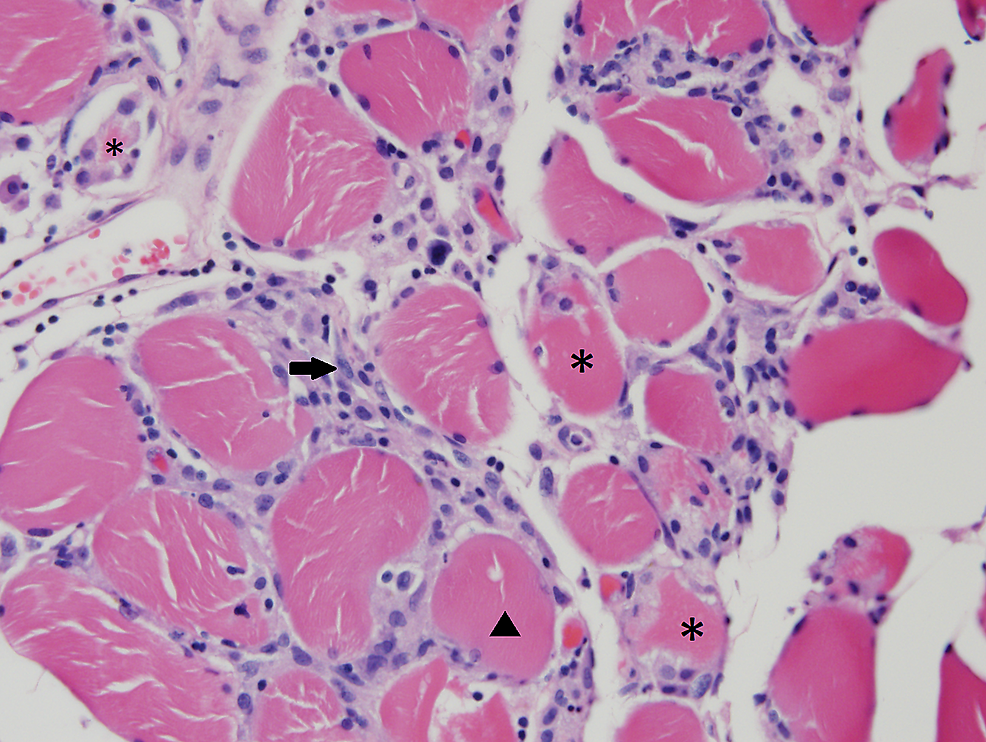 Cureus Paraneoplastic Necrotizing Myopathy Post Lumpectomy And