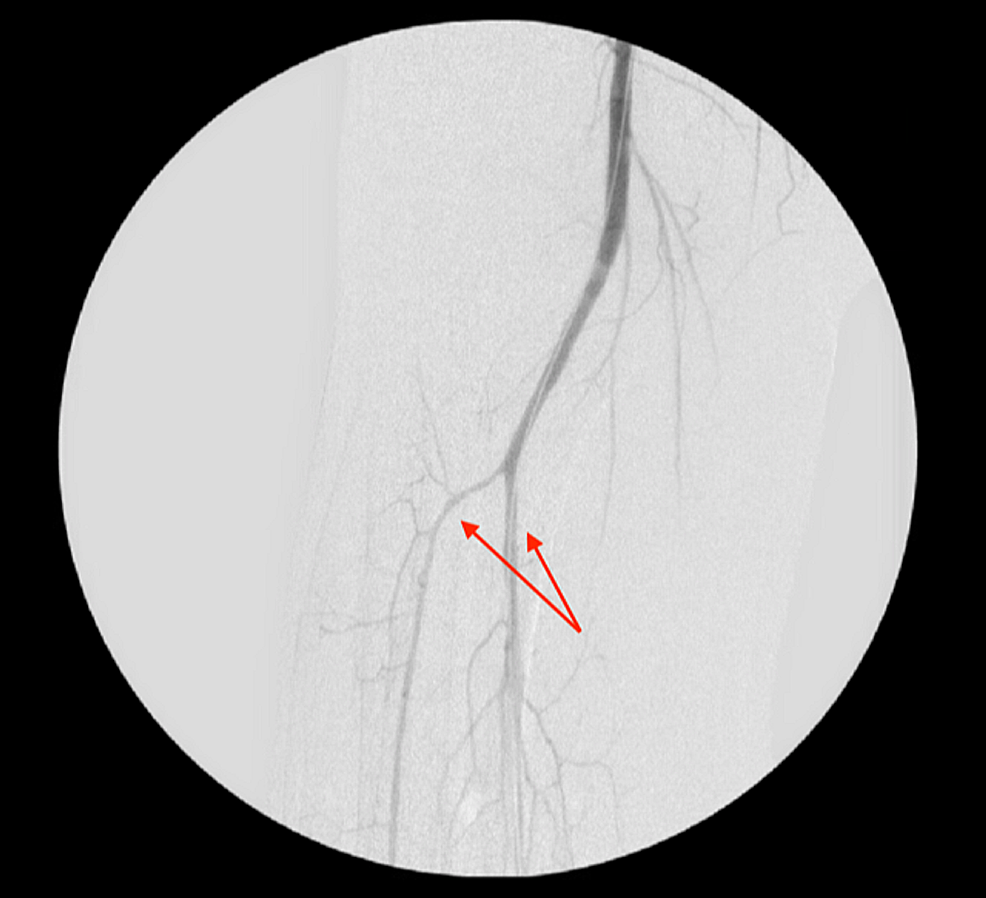 Angiogram-indicating-right-tibioperoneal-trunk-after-balloon-angioplasty-(arrows)