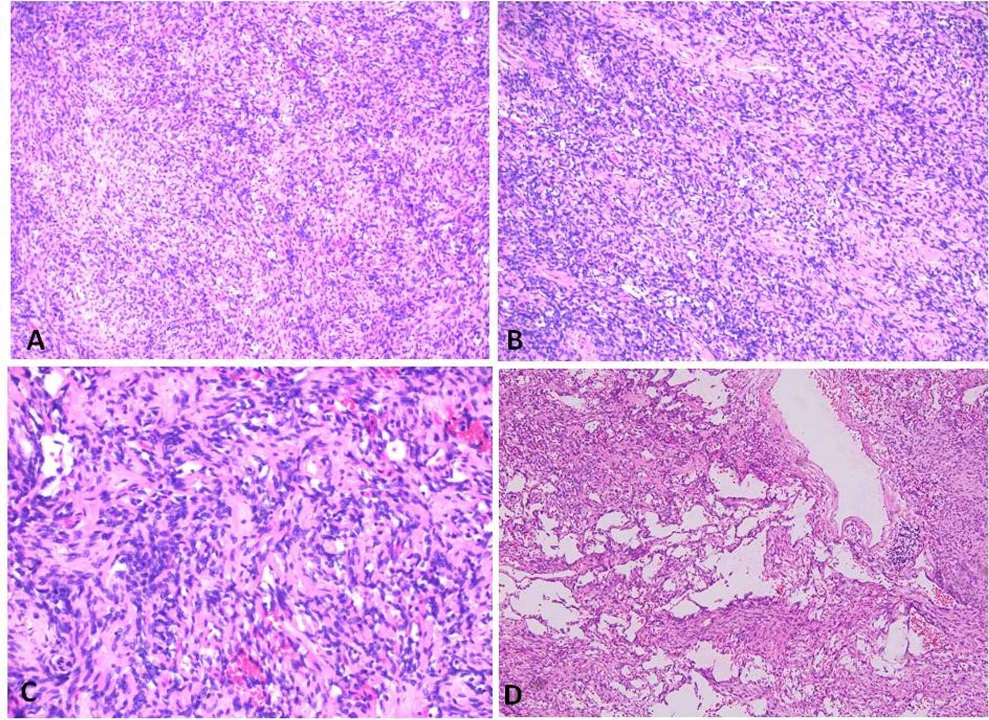 Cureus | Solitary Fibrous Tumor of Pancreas With Unusual Features: A ...