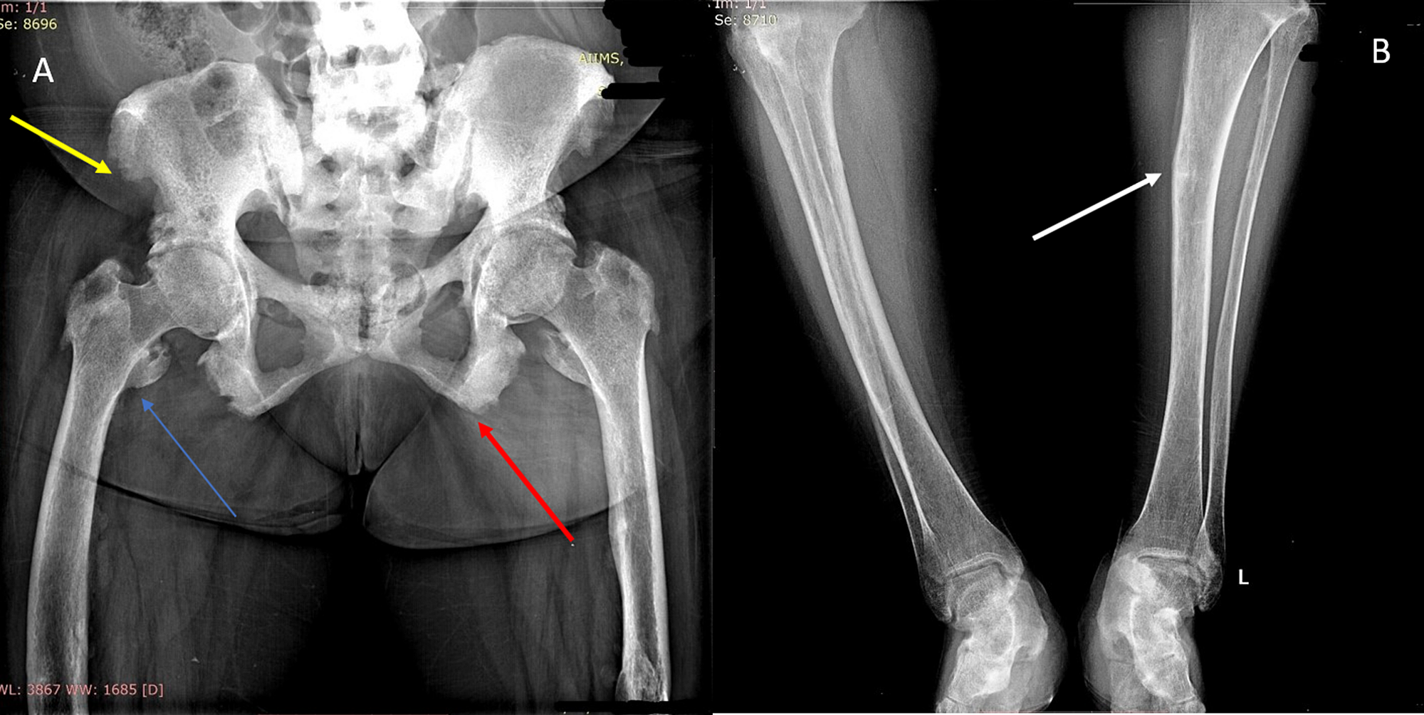 Rickets Disease X Rays